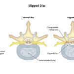 Thoát vị đĩa đệm và thoát vị đĩa đệm L4 L5 và phác đồ điều trị Thoát vị đĩa đệm là căn bệnh khá phổ biến