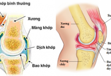 Dịch tràn khớp gối: Nguyên nhân và cách chữa trị