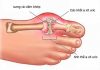 Gout là gì: nguyên nhân và cách chữa trị