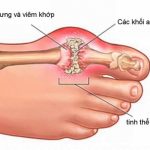 Gout là gì: nguyên nhân và cách chữa trị