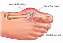 Gout là gì: nguyên nhân và cách chữa trị